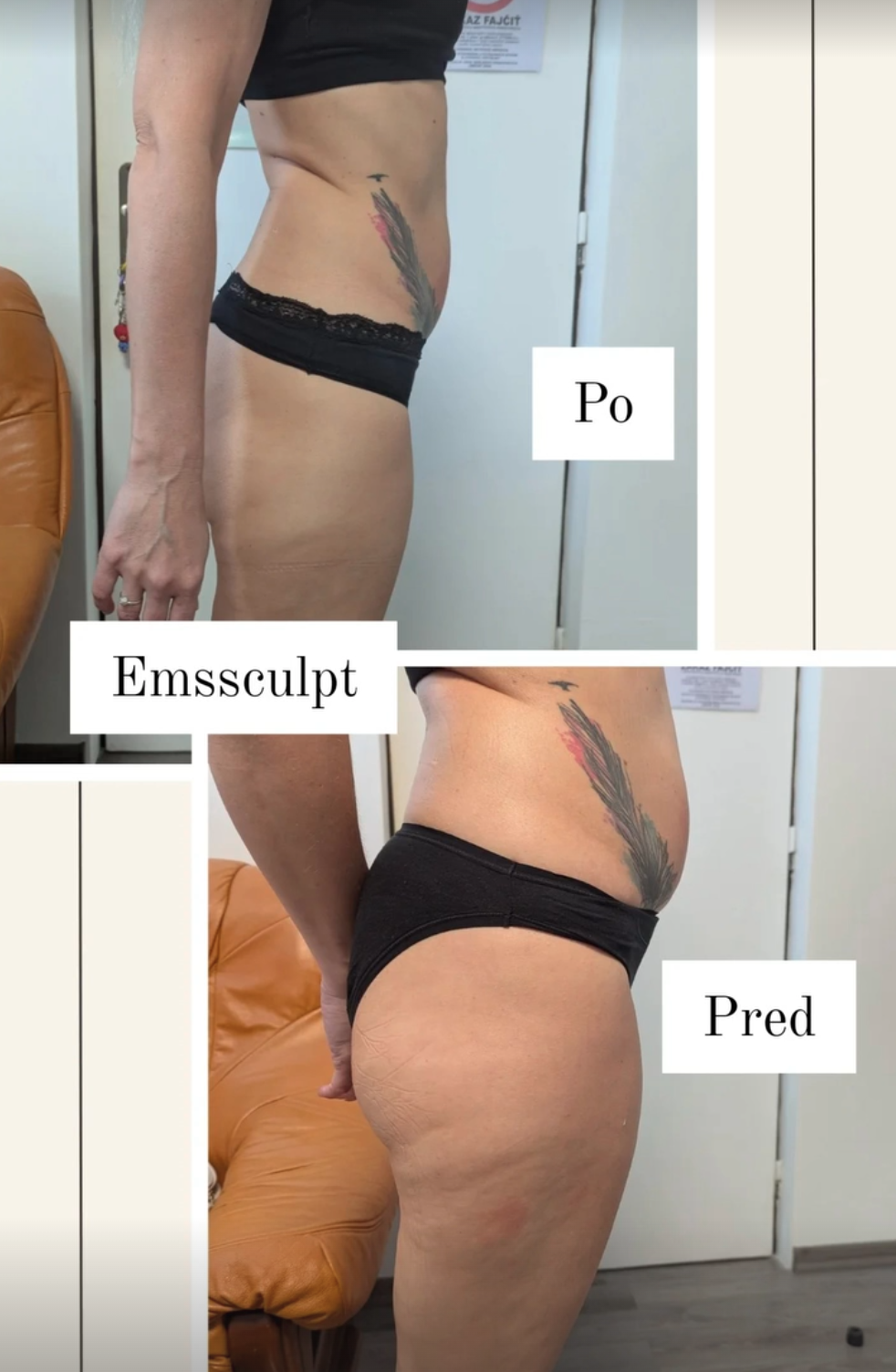 Viditeľné výsledky — pred a po ošetrení Emsculpt